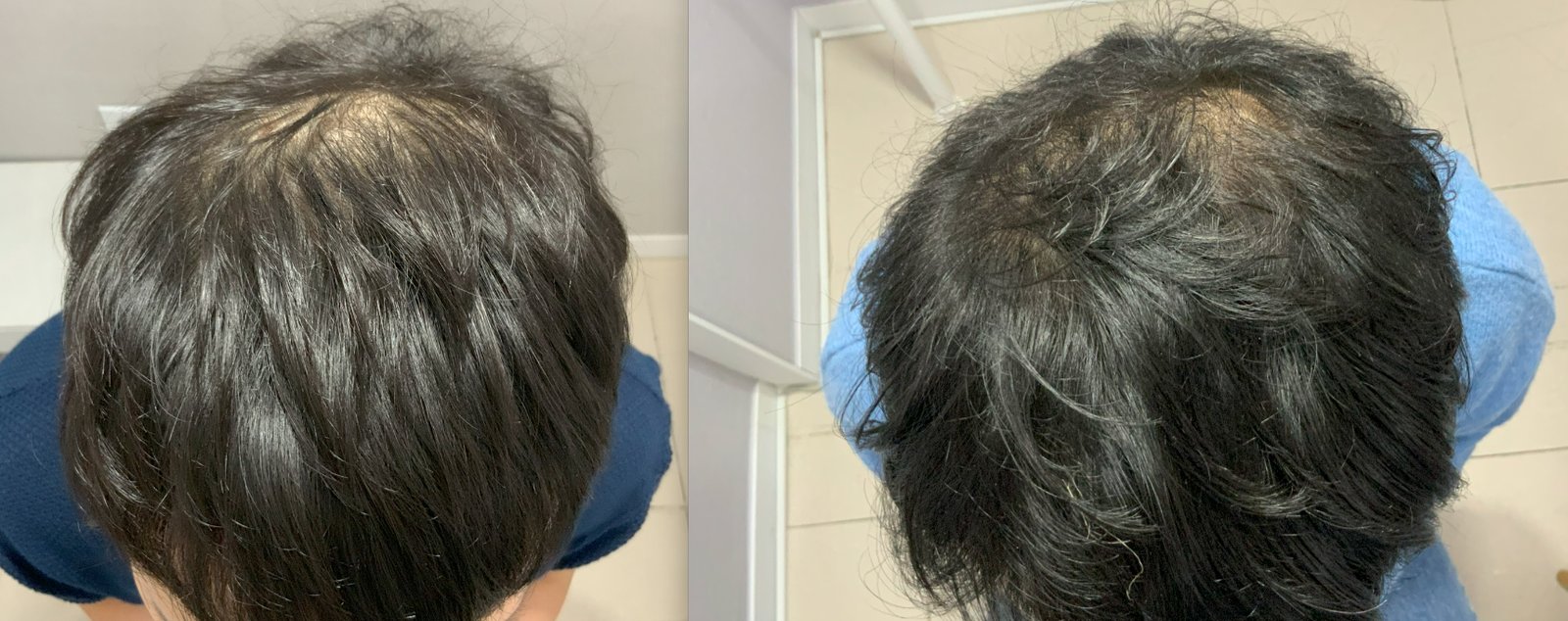 頭頂部 メソセラピーの症例写真(30代後半 男性・6ヶ月経過)|ヨンセモベル医院 鍾路本店