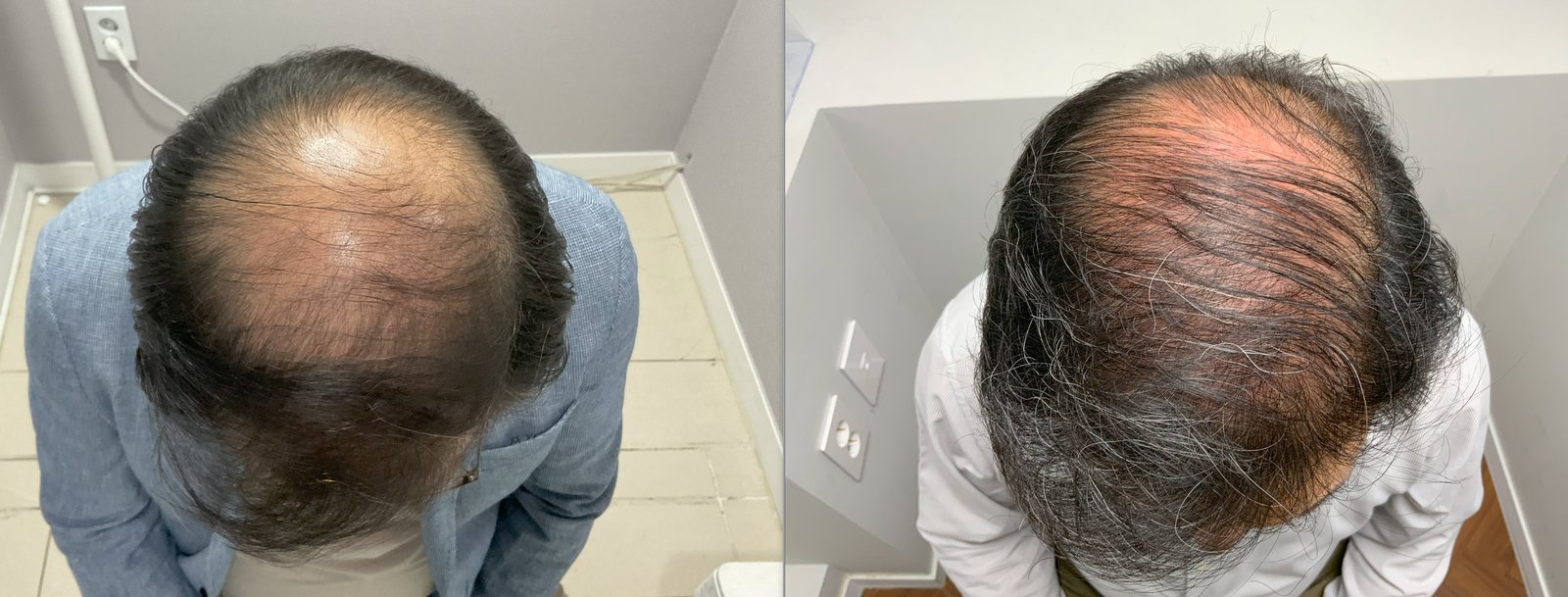 前頭部 自毛植毛の症例写真(60代前半 男性・1年経過)|ヨンセモベル医院 鍾路本店