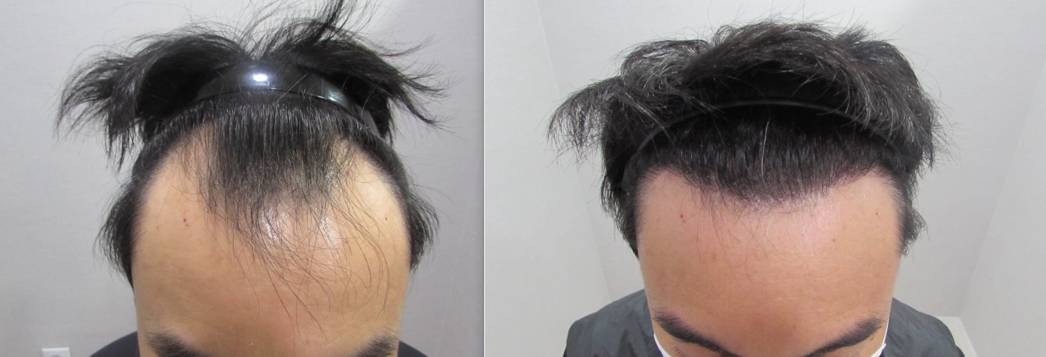 ヘアライン矯正の症例写真(40代前半 男性・9ヶ月経過)|ヨンセモベル医院 鍾路本店