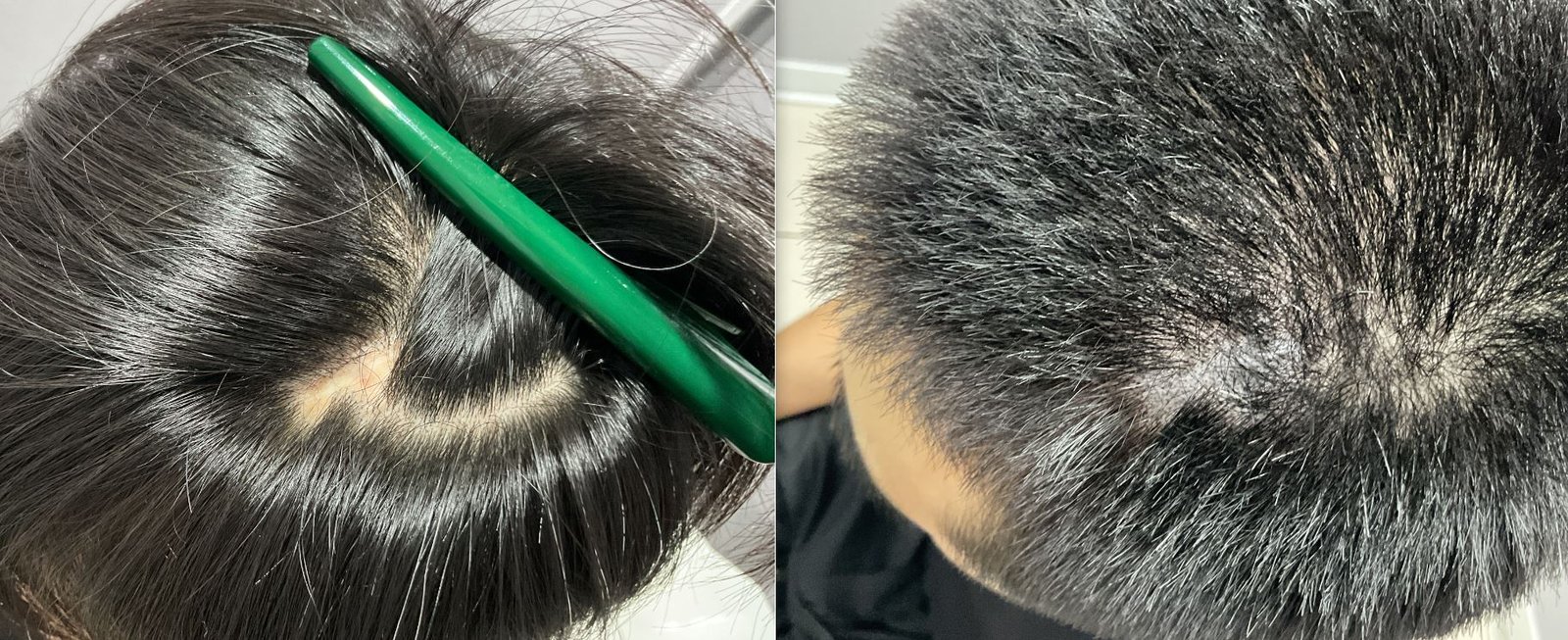 傷跡部位 SMPの症例写真(20代 男性・—)|ヨンセモベル医院 鍾路本店